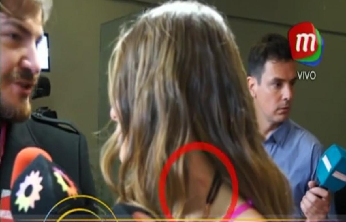 El chupón en el cuello de la modelo
